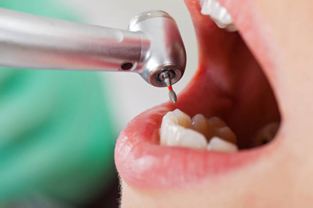Best Chipped Tooth Repair Near Me  in Friona, TX